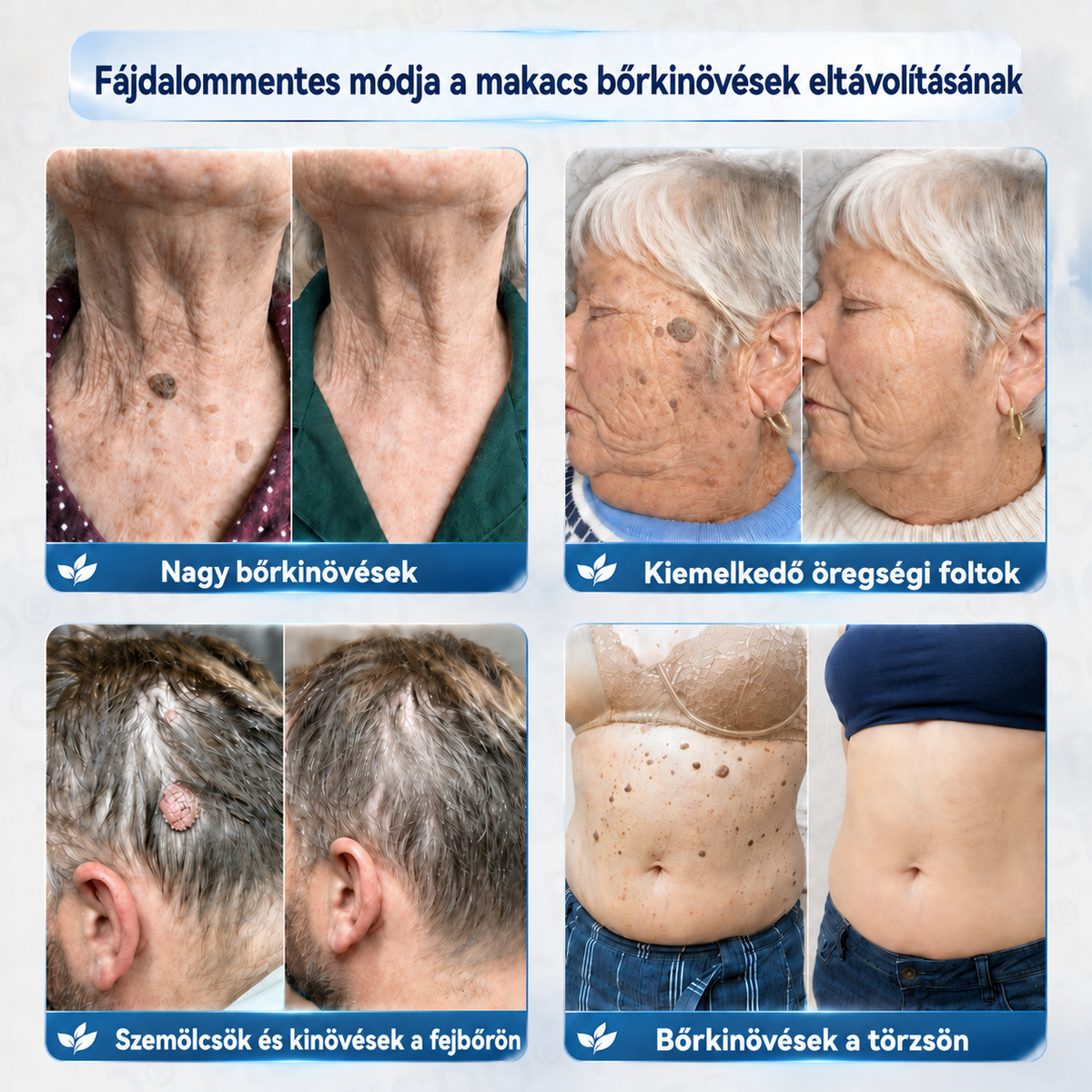🔥 Picdo® 7 napos Bőrnövedék- és Foltápoló Krém | 🌿 Célzott Növényi Formula | ✨ Simább Bőr | 🇭🇺 Magyarországon gyártva