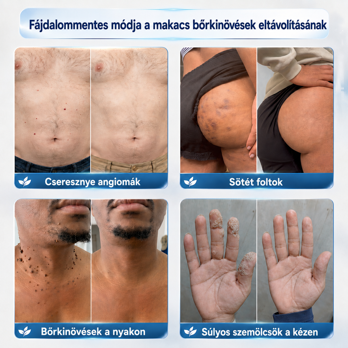 🔥 Picdo® 7 napos Bőrnövedék- és Foltápoló Krém | 🌿 Célzott Növényi Formula | ✨ Simább Bőr | 🇭🇺 Magyarországon gyártva