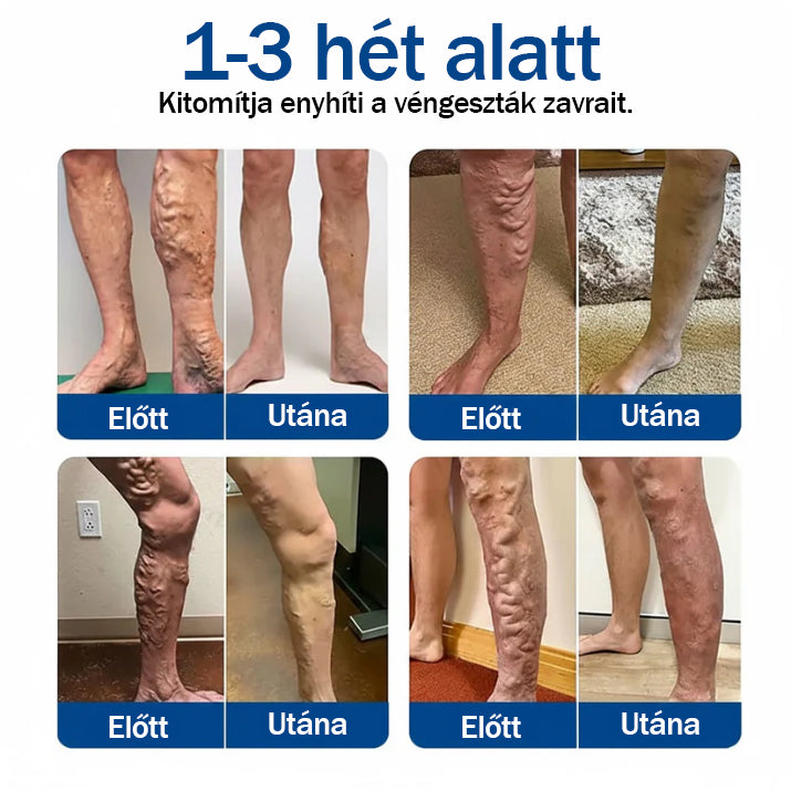 🧑‍⚕️ Medistart® Visszérápoló Mikrotűs Gondozó Tapasz ⚡ Azonnali Megkönnyebbülés, Hosszú Távú Eredmények