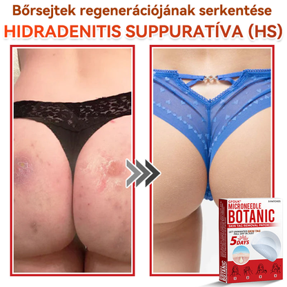 🍀 GFOUK® Mikrotűs Bőrkinövés & Foltápoló Tapasz ✨ | 9 db Természetes Növényi Hatóanyagú Bőrmegújító Patch 🌿 Bőrkinövések, Szemölcsök, Anyajegyek és Pigmentfoltok Célzott Ápolására