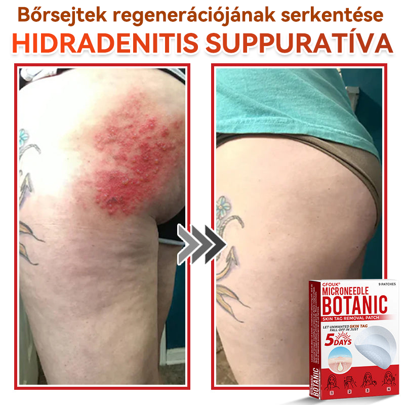 🍀 GFOUK® Mikrotűs Bőrkinövés & Foltápoló Tapasz ✨ | 9 db Természetes Növényi Hatóanyagú Bőrmegújító Patch 🌿 Bőrkinövések, Szemölcsök, Anyajegyek és Pigmentfoltok Célzott Ápolására