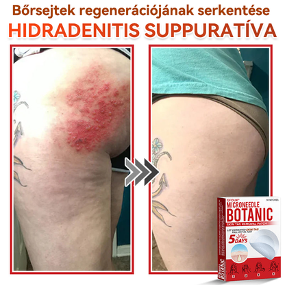 🍀 GFOUK® Mikrotűs Bőrkinövés & Foltápoló Tapasz ✨ | 9 db Természetes Növényi Hatóanyagú Bőrmegújító Patch 🌿 Bőrkinövések, Szemölcsök, Anyajegyek és Pigmentfoltok Célzott Ápolására