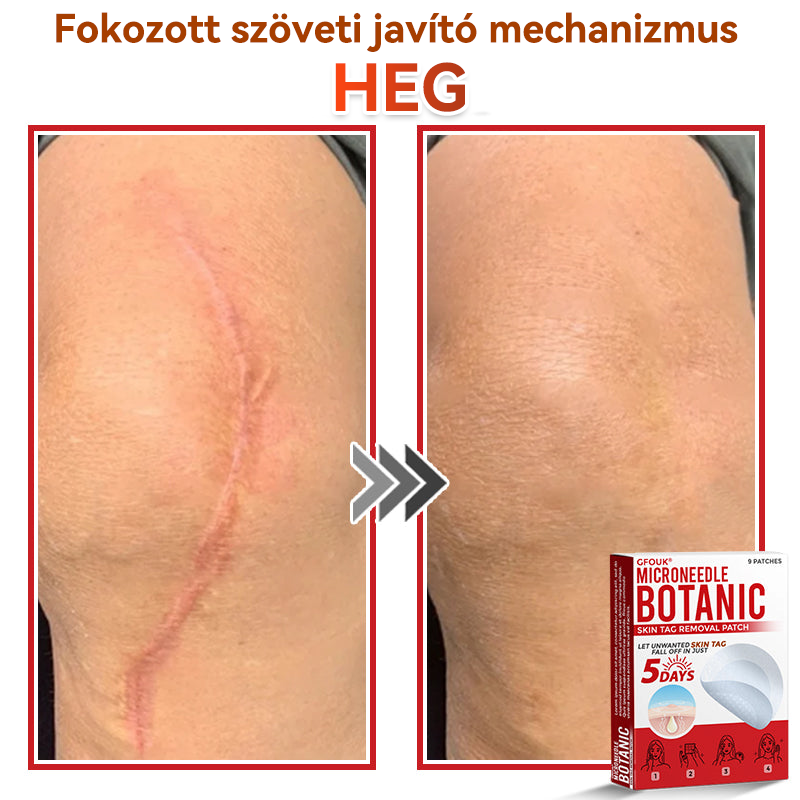 🍀 GFOUK® Mikrotűs Bőrkinövés & Foltápoló Tapasz ✨ | 9 db Természetes Növényi Hatóanyagú Bőrmegújító Patch 🌿 Bőrkinövések, Szemölcsök, Anyajegyek és Pigmentfoltok Célzott Ápolására