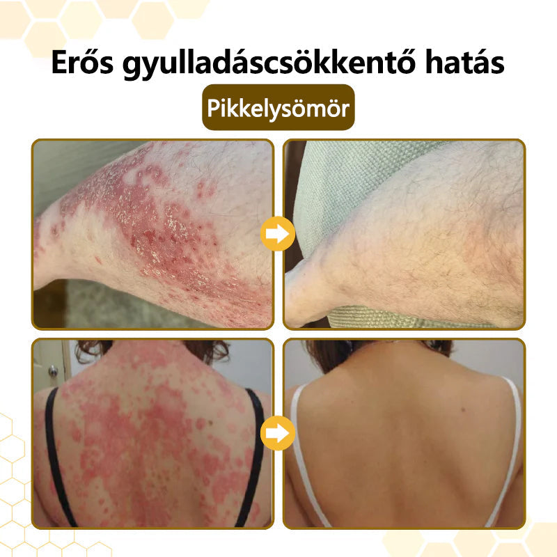 ⚡ 60 Másodperces Viszketéscsillapítás 🐝 CleraNaure® Méhméreg Krém | Természetes Bőrregeneráló Megoldás Pikkelysömörre
