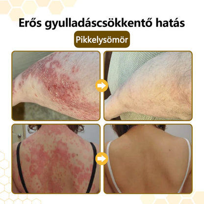 ⚡ 60 Másodperces Viszketéscsillapítás 🐝 CleraNaure® Méhméreg Krém | Természetes Bőrregeneráló Megoldás Pikkelysömörre