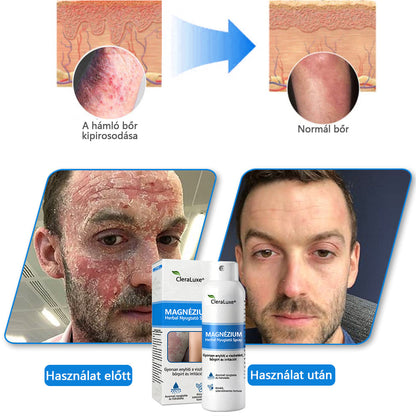 CleraNature® Magnéziumos Gyógyfüves Bőrnyugtató Spray ✨ – Természetes Növényi Formula Száraz, Érzékeny és Problémás Bőr Mindennapi Ápolására 🌿