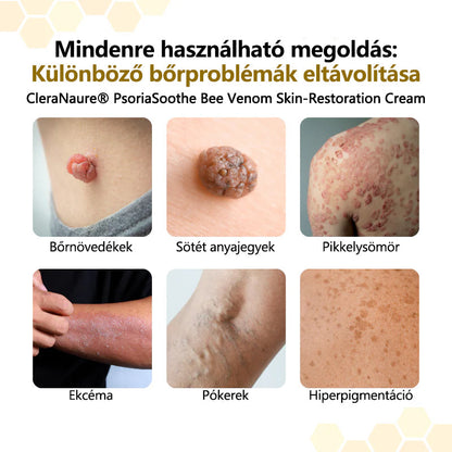 ⚡ 60 Másodperces Viszketéscsillapítás 🐝 CleraNaure® Méhméreg Krém | Természetes Bőrregeneráló Megoldás Pikkelysömörre