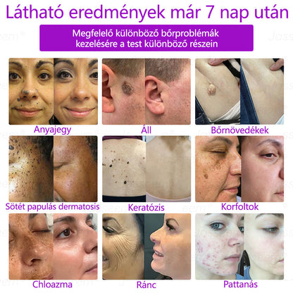 𝐉𝐚𝐬𝐬𝐞𝐞𝐦® Fejlett, nem invazív bőrjavító CO₂ lézeres toll 🎉 (Gyengéden eltávolítja a szemölcsöket, anyajegyeket, öregségi foltokat és bőrkinövéseket – fájdalom és gond nélkül!)