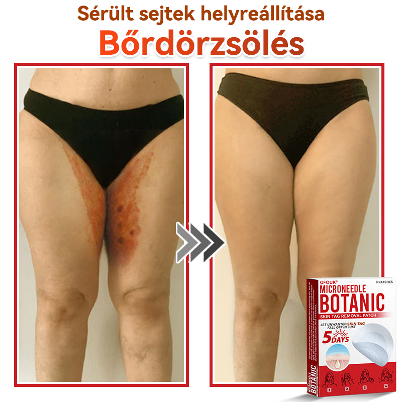 🍀 GFOUK® Mikrotűs Bőrkinövés & Foltápoló Tapasz ✨ | 9 db Természetes Növényi Hatóanyagú Bőrmegújító Patch 🌿 Bőrkinövések, Szemölcsök, Anyajegyek és Pigmentfoltok Célzott Ápolására