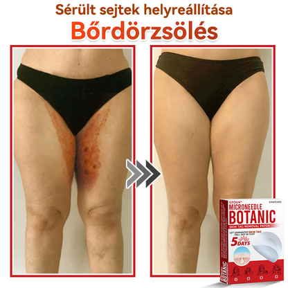 🍀 GFOUK® Mikrotűs Bőrkinövés & Foltápoló Tapasz ✨ | 9 db Természetes Növényi Hatóanyagú Bőrmegújító Patch 🌿 Bőrkinövések, Szemölcsök, Anyajegyek és Pigmentfoltok Célzott Ápolására