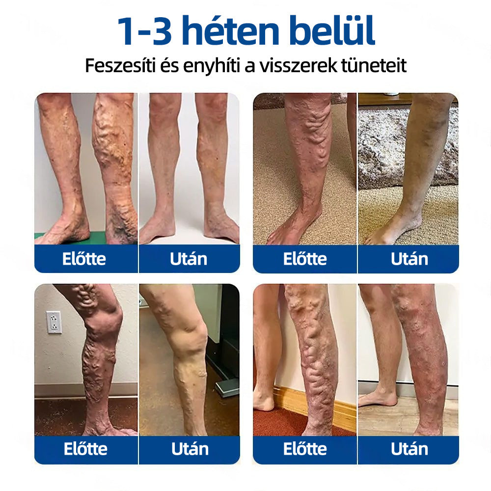 Healrize® VeinTarget™ Mikrotűs Tapasz – Segít Csökkenteni a Lábfáradtságot, Duzzanatot és Támogatja az Egészséges Vénás Keringést 🦵🌿