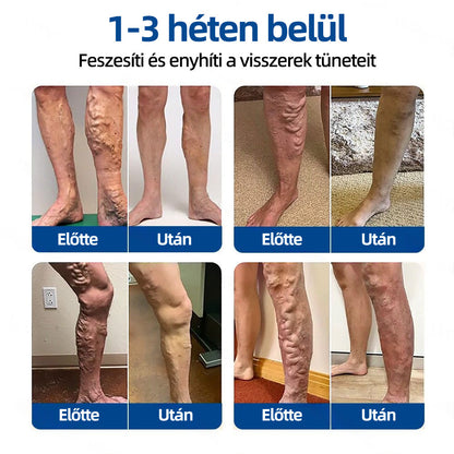 Healrize® VeinTarget™ Mikrotűs Tapasz – Segít Csökkenteni a Lábfáradtságot, Duzzanatot és Támogatja az Egészséges Vénás Keringést 🦵🌿
