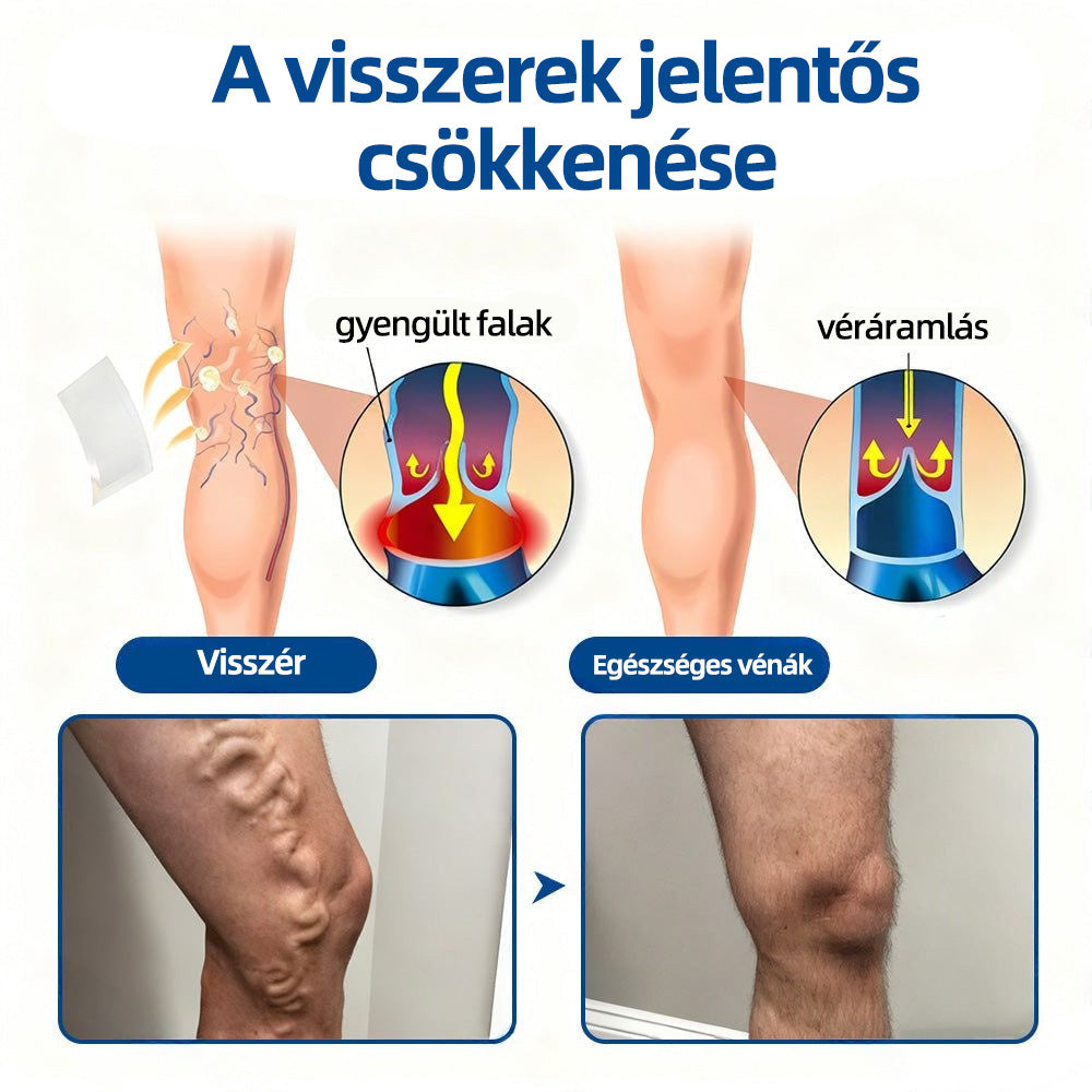 Healrize® VeinTarget™ Mikrotűs Tapasz – Segít Csökkenteni a Lábfáradtságot, Duzzanatot és Támogatja az Egészséges Vénás Keringést 🦵🌿