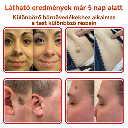 🍀 GFOUK® Mikrotűs Bőrkinövés & Foltápoló Tapasz ✨ | 9 db Természetes Növényi Hatóanyagú Bőrmegújító Patch 🌿 Bőrkinövések, Szemölcsök, Anyajegyek és Pigmentfoltok Célzott Ápolására