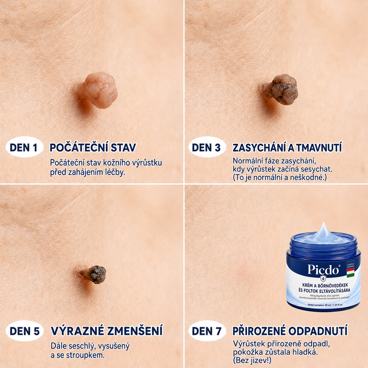 🔥 Picdo® 7 napos Bőrnövedék- és Foltápoló Krém | 🌿 Célzott Növényi Formula | ✨ Simább Bőr | 🇭🇺 Magyarországon gyártva