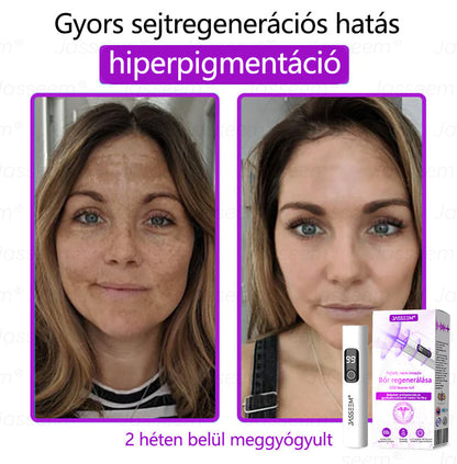 𝐉𝐚𝐬𝐬𝐞𝐞𝐦® Fejlett, nem invazív bőrjavító CO₂ lézeres toll 🎉 (Gyengéden eltávolítja a szemölcsöket, anyajegyeket, öregségi foltokat és bőrkinövéseket – fájdalom és gond nélkül!)
