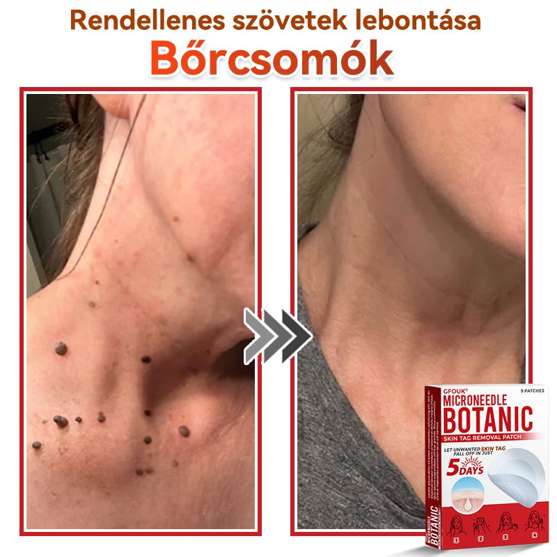 🍀 GFOUK® Mikrotűs Bőrkinövés & Foltápoló Tapasz ✨ | 9 db Természetes Növényi Hatóanyagú Bőrmegújító Patch 🌿 Bőrkinövések, Szemölcsök, Anyajegyek és Pigmentfoltok Célzott Ápolására