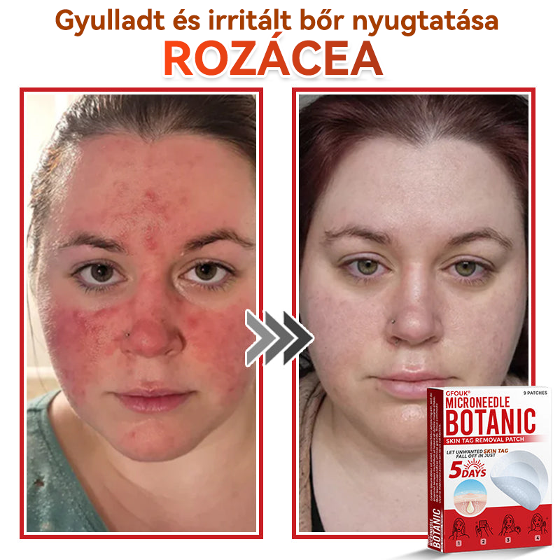 🍀 GFOUK® Mikrotűs Bőrkinövés & Foltápoló Tapasz ✨ | 9 db Természetes Növényi Hatóanyagú Bőrmegújító Patch 🌿 Bőrkinövések, Szemölcsök, Anyajegyek és Pigmentfoltok Célzott Ápolására