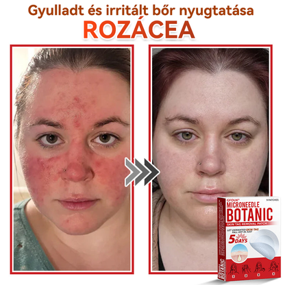🍀 GFOUK® Mikrotűs Bőrkinövés & Foltápoló Tapasz ✨ | 9 db Természetes Növényi Hatóanyagú Bőrmegújító Patch 🌿 Bőrkinövések, Szemölcsök, Anyajegyek és Pigmentfoltok Célzott Ápolására