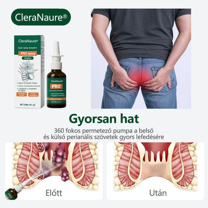 CleraNaure® Gyors Hatású Aranyér PRO Spray 🌿 – Természetes Növényi Formula a Kényelmesebb Ülésért és Mozgásért 🎁