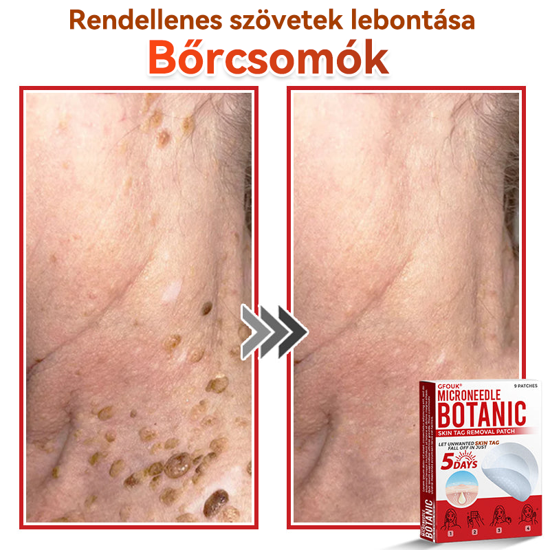 🍀 GFOUK® Mikrotűs Bőrkinövés & Foltápoló Tapasz ✨ | 9 db Természetes Növényi Hatóanyagú Bőrmegújító Patch 🌿 Bőrkinövések, Szemölcsök, Anyajegyek és Pigmentfoltok Célzott Ápolására