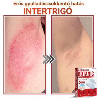 🍀 GFOUK® Mikrotűs Bőrkinövés & Foltápoló Tapasz ✨ | 9 db Természetes Növényi Hatóanyagú Bőrmegújító Patch 🌿 Bőrkinövések, Szemölcsök, Anyajegyek és Pigmentfoltok Célzott Ápolására